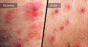 Detoxifiere eczeme. 6 feluri de a trata eczema in mod natural. | constiintaortodoxa.ro